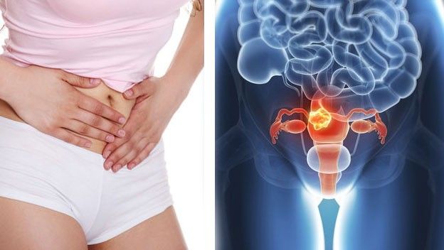 En Argentina el cáncer de cuello uterino mata a 2.500 mujeres al año: ¿cómo prevenirlo?