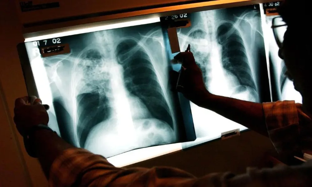 Argentina ya registra más de 13.000 casos de tuberculosis con un avance sostenido de la enfermedad