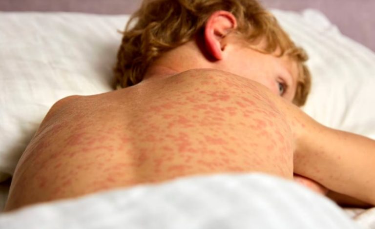 Alerta nacional por sarampión: niño diagnosticado en Santa Elena, Entre Ríos