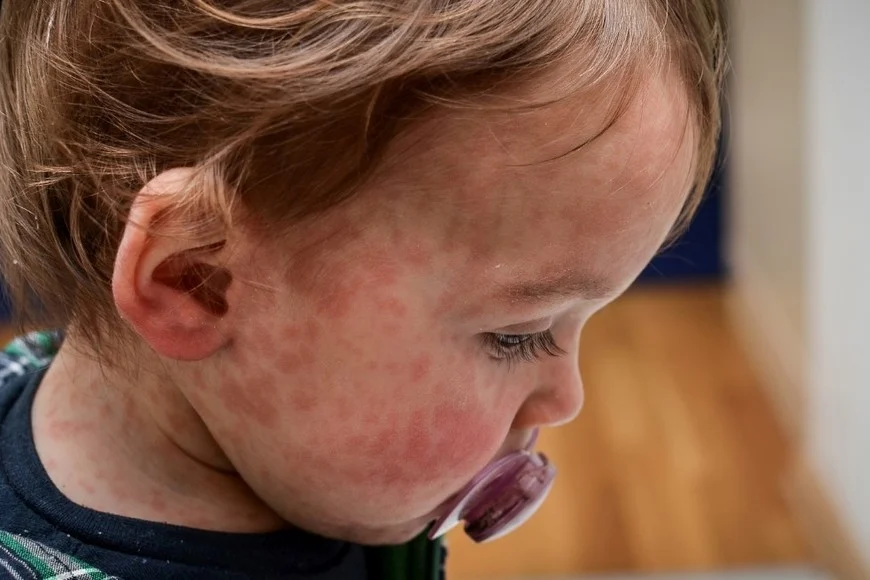 Sarampión y coqueluche reaparecen en Argentina por baja vacunación