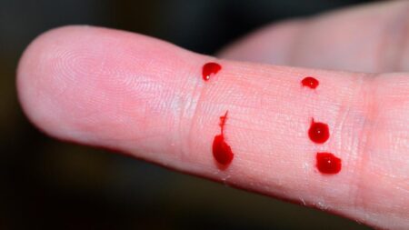 Hemofilia: ANMAT aprueba un tratamiento innovador para casos críticos